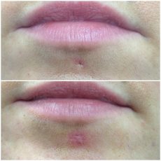 vorher: Lippen mit Piercingnarbe in der Unterlippe, nachher: Piercingnarbe leichte Rötung mit genähter Narbe