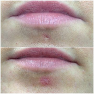 jenniferclaus.de_piercingnarbenentfernung_Lippe_justyna vorher: Lippen mit Piercingnarbe in der Unterlippe, nachher: Piercingnarbe leichte Rötung mit genähter Narbe