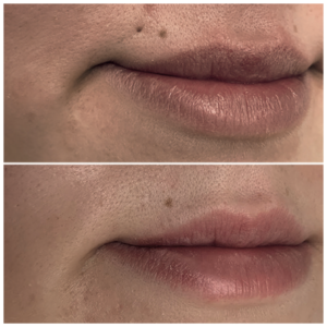 Lippe mit Piercingnarbe vor und nach der Piercingnarbenentfernung