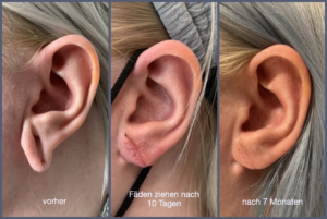vorher-nachher Fotos von einem linken Ohr bei dem das Ohr vorher ein gedehntes Ohrloch zeigt in dem ein Tunnel getragen wurde, das nachher Foto zeigt das verschlossene abgeheilte Ohrloch mit einer natürlichen Form des Ohrläppchens